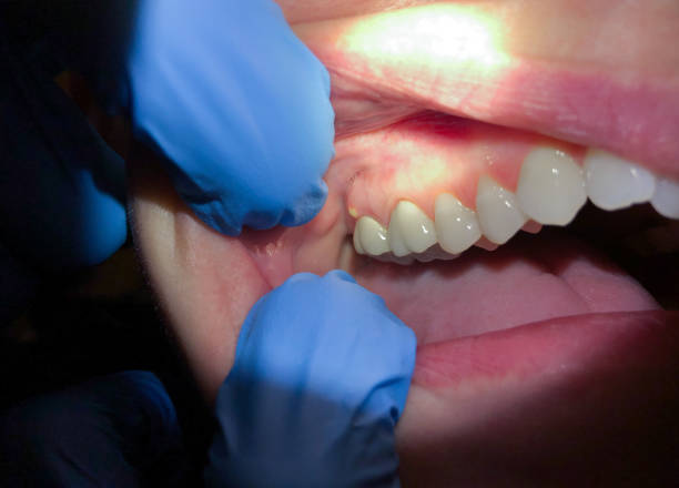 Best Emergency Wisdom Tooth Extraction in Black Rock, NM